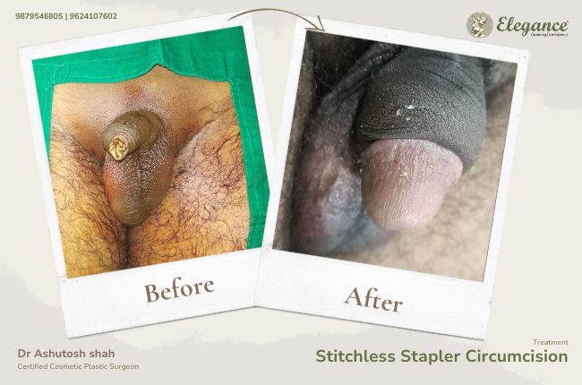 Stitchless Stapler Circumcision (12)
