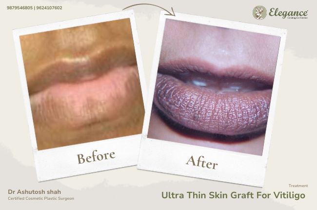 Ultra Thin Skin Graft For Vitiligo (2)