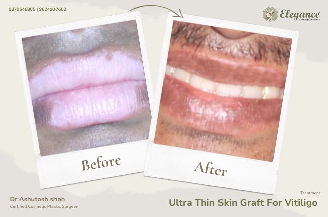Ultra Thin Skin Graft For Vitiligo (3)