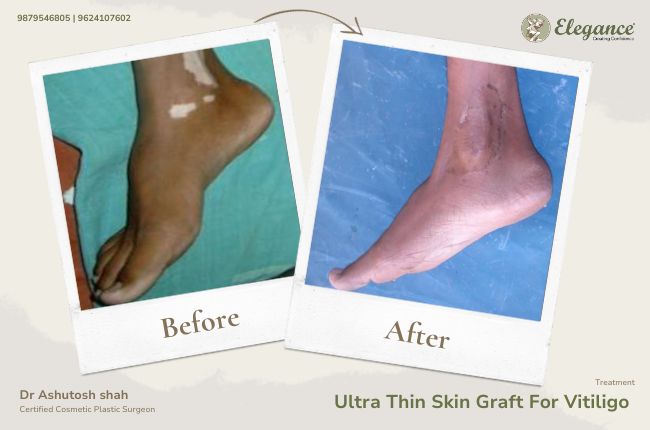 Ultra Thin Skin Graft For Vitiligo