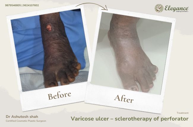 Varicose ulcer – sclerotherapy of perforator