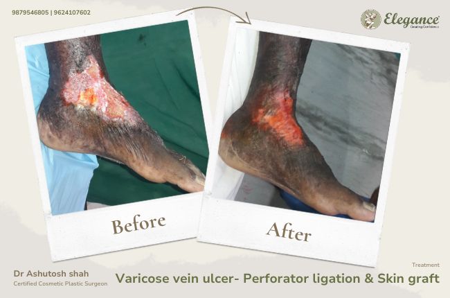 Varicose vein ulcer- Perforator ligation _ Skin graft (2)