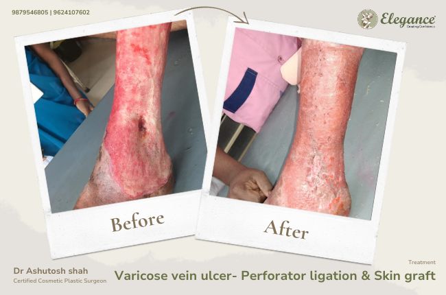 Varicose vein ulcer- Perforator ligation _ Skin graft