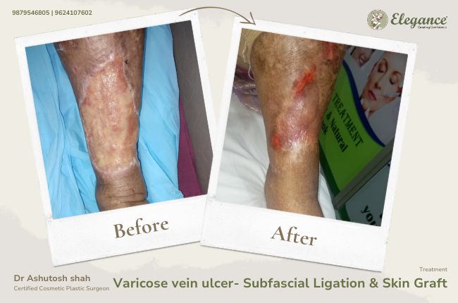 Varicose vein ulcer- Subfascial Ligation _ Skin Graft