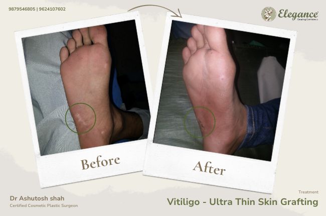 Vitiligo - Ultra Thin Skin Grafting (2)