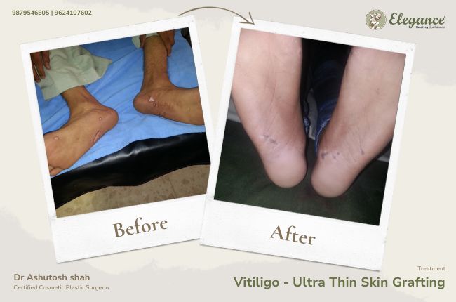 Vitiligo - Ultra Thin Skin Grafting