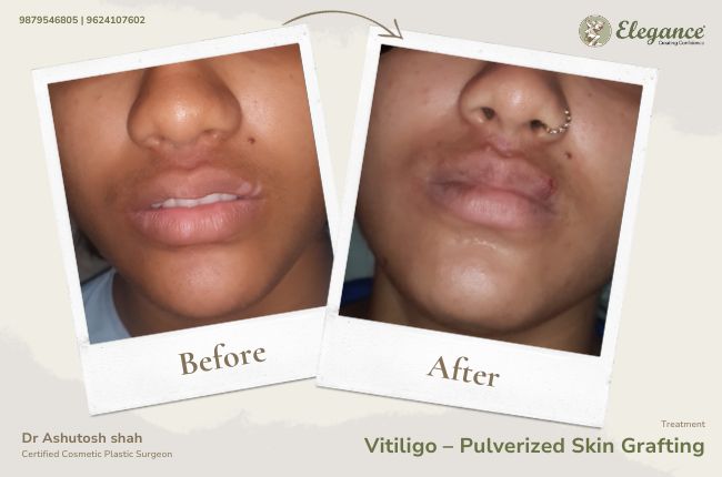 Vitiligo – Pulverized Skin Grafting (2)