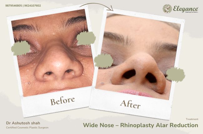 Wide Nose GÇô Rhinoplasty Alar Reduction