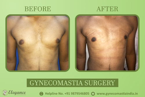 best-gynecomastia-clinic-in-valsad