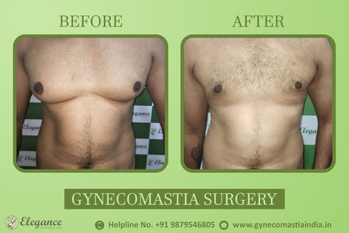 best-gynecomastia-doctor-in-ankleswar