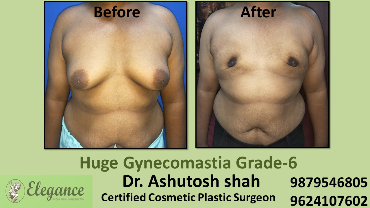 breast-roll-with-back-roll-gynecomastia-grade-6-kosamba-gujarat-india-A