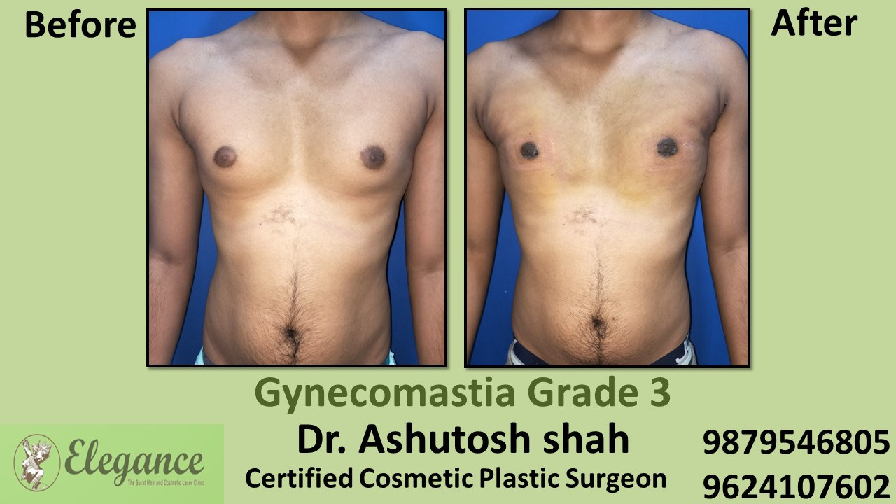 grade-3-gynecomastia-treatment-in-bardoli-gujarat-A