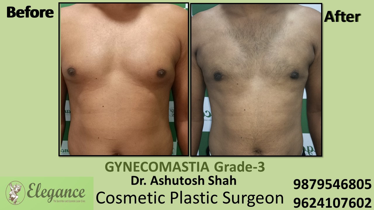gynecomastia-grade-3-slight-breast-roll-surgery-valsad-gujarat-india-A