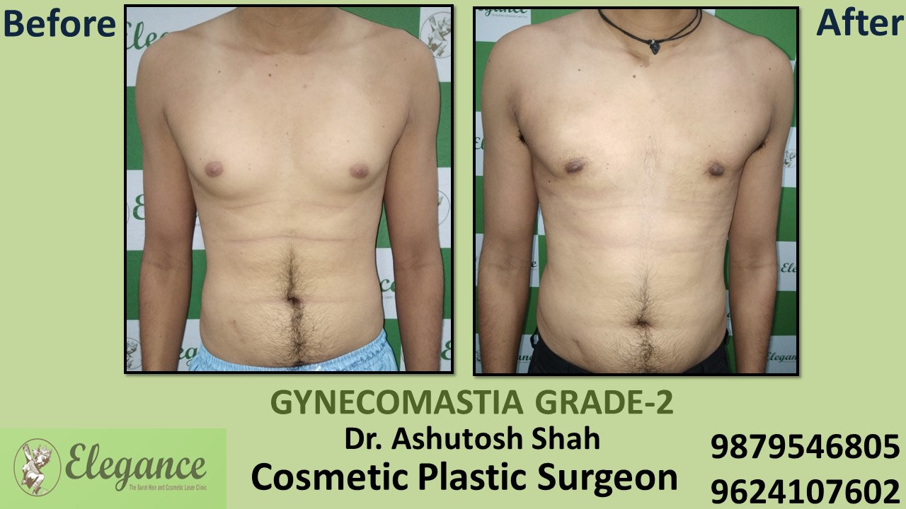 gynecomastia-rounded-chest-grade-2-surgery-bharuch-gujarat-A