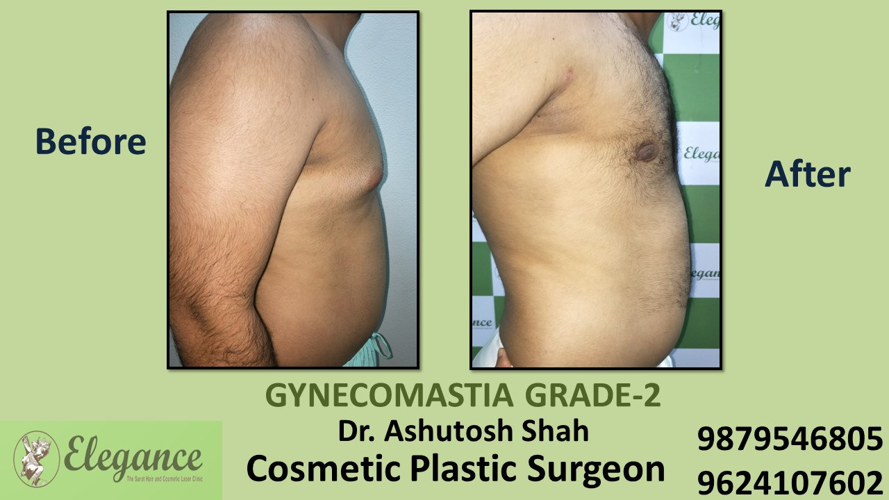 gynecomastia-rounded-chest-grade-2-surgery-vapi-gujarat-A