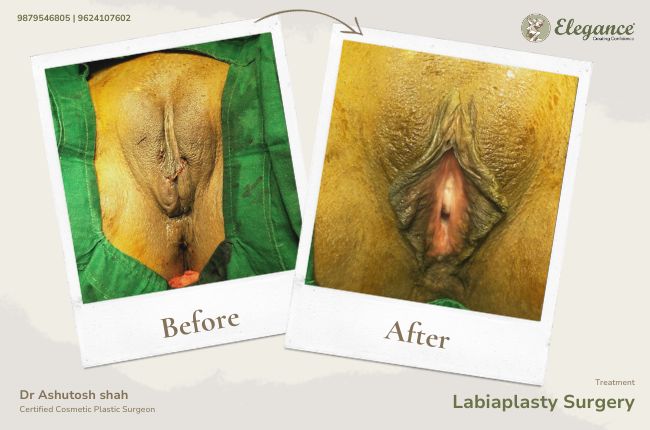 lebiaplasty-surgery-surat