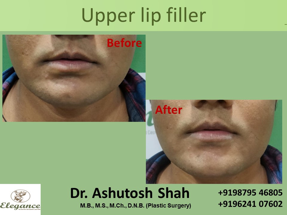 lip-filler-treatment-bardoli-gujarat-india-01