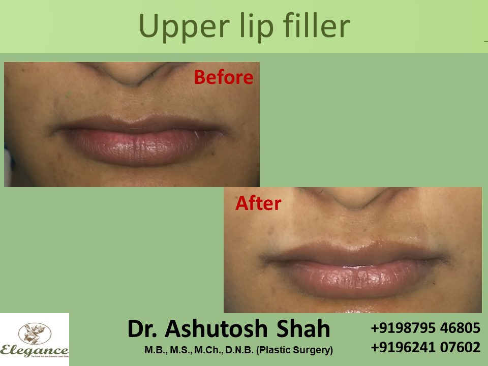 lip-filler-treatment-surat-gujarat-india-01