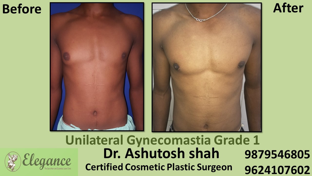 male-breast-reduction-surgery-bilimora-gujaratA