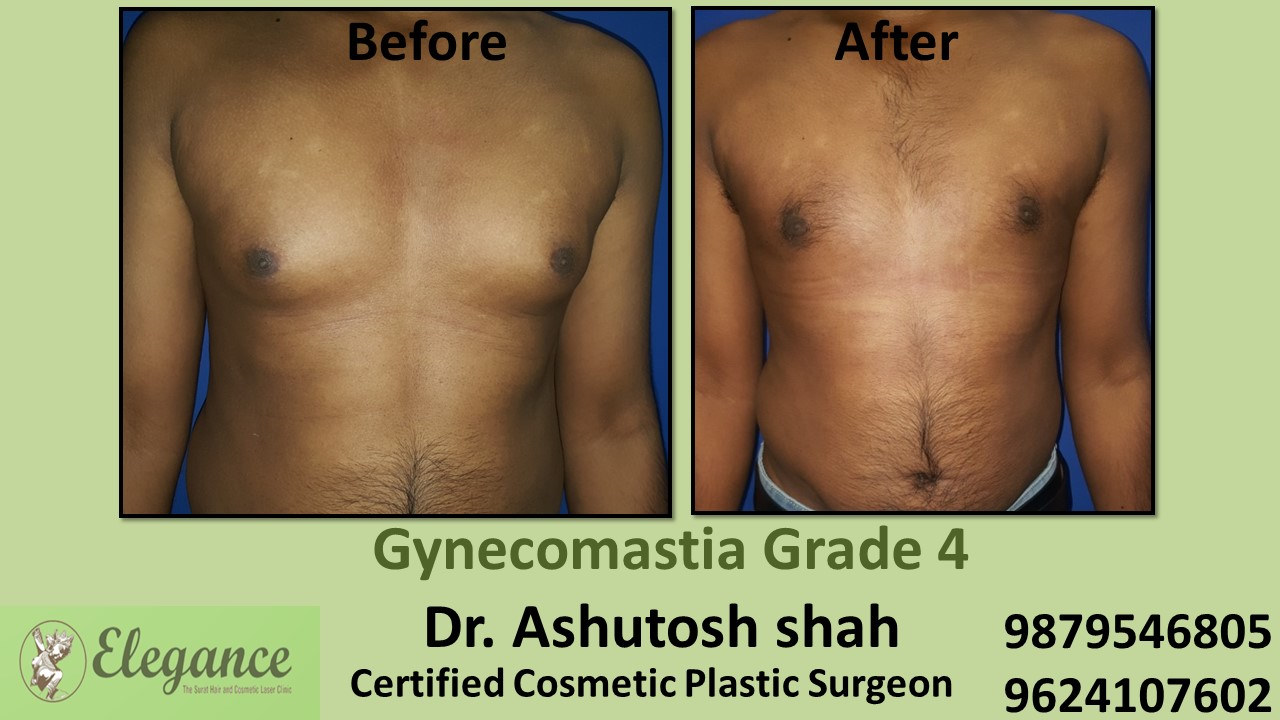 male-large-breast-surgery-results-in-baroda-gujarat-A