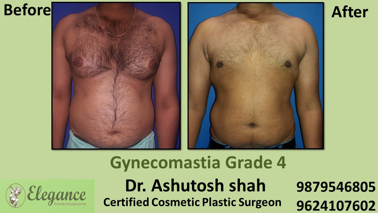 male-large-breast-surgery-results-in-valsad-gujarat-A