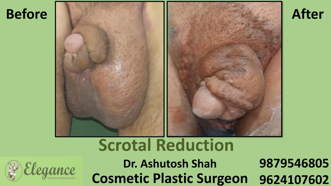 scrotal-reduction-surgery-in-vesu-adajan-surat