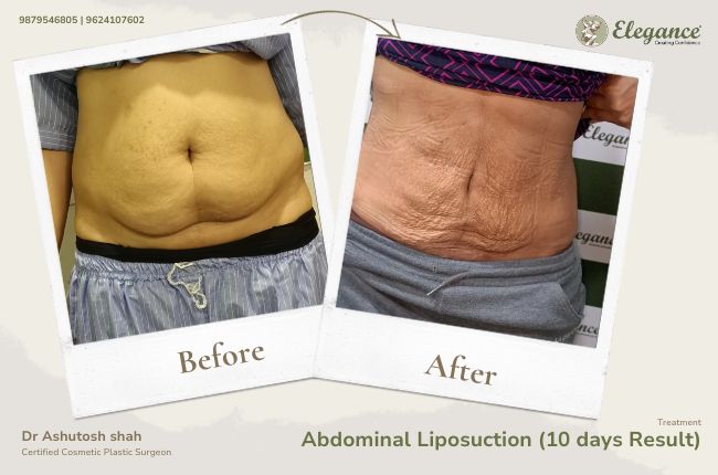Abdominal Liposuction (10 days Result) (1)