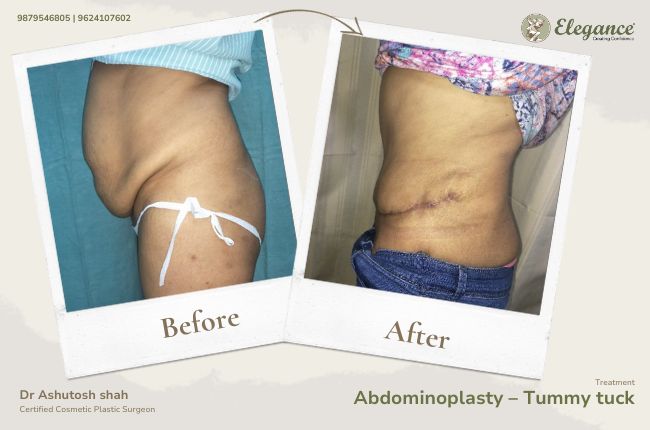 Abdominoplasty – Tummy tuck