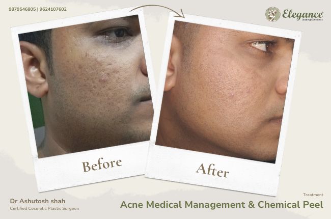 Acne Medical Management & Chemical Peel (2)