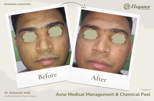Acne Medical Management & Chemical Peel