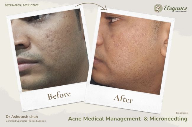 Acne Medical Management & Microneedling