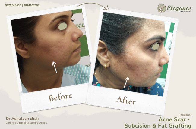 Acne Scar - Subcision & Fat Grafting
