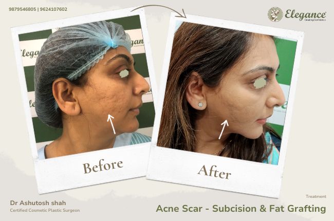 Acne Scar - Subcision & Fat Grafting (2)