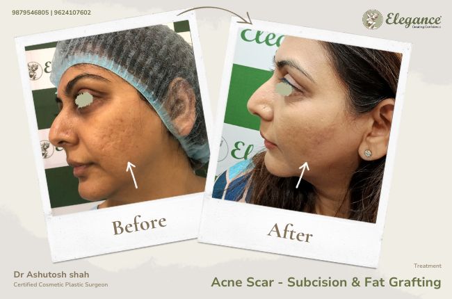 Acne Scar - Subcision & Fat Grafting (3)