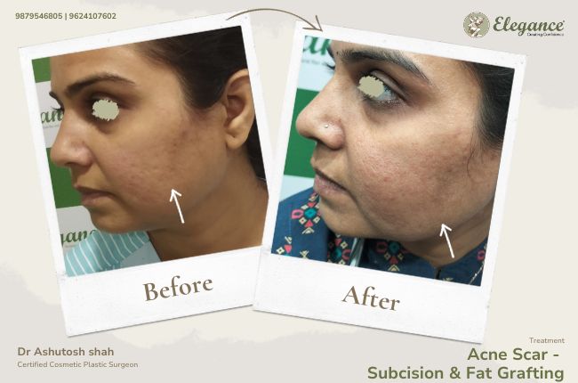 Acne Scar - Subcision & Fat Grafting