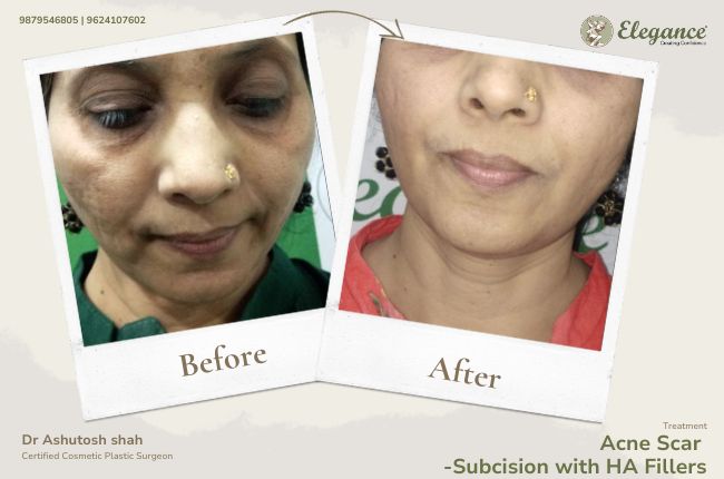 Acne Scar -Subcision with HA Fillers