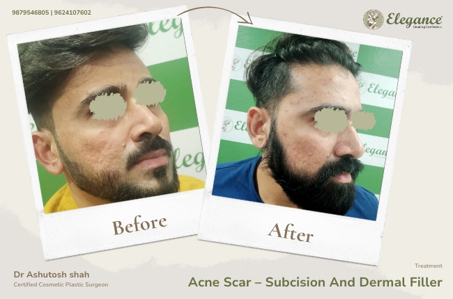 Acne Scar – Subcision And Dermal Filler 6