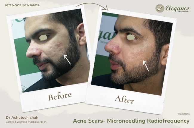 Acne Scars- Microneedling Radiofrequency (2)