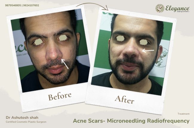 Acne Scars- Microneedling Radiofrequency