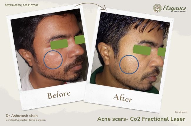 Acne scars- Co2 Fractional Laser (4)