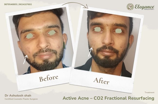 Active Acne GÇô CO2 Fractional Resurfacing