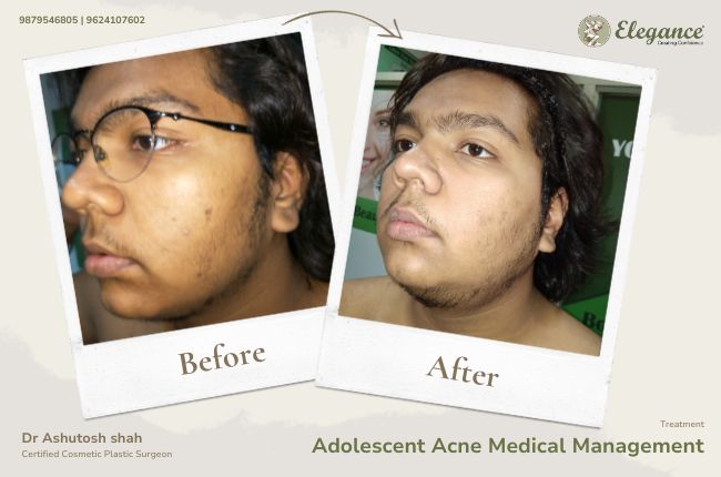 Adolescent Acne Medical Management