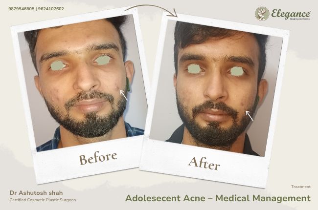 Adolesecent Acne GÇô Medical Management