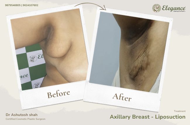 Axillary Breast - Liposuction 1