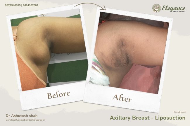 Axillary Breast - Liposuction 2