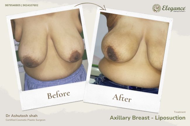 Axillary Breast - Liposuction 3