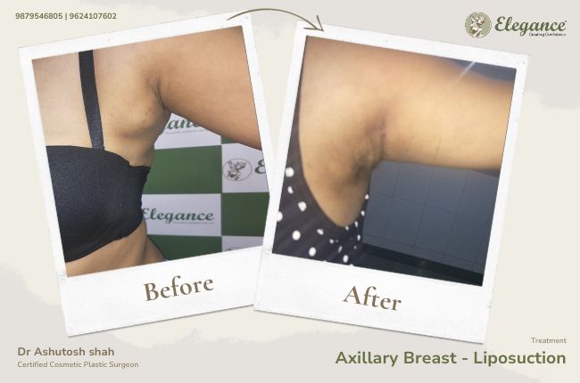 Axillary Breast - Liposuction 4