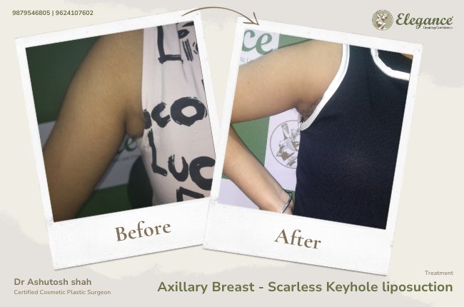 Axillary Breast - Scarless Keyhole liposuction 1