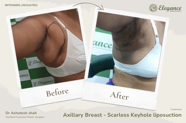 Axillary Breast - Scarless Keyhole liposuction 2