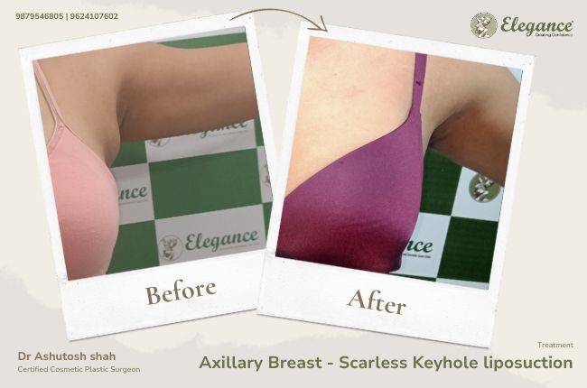 Axillary Breast - Scarless Keyhole liposuction 3
